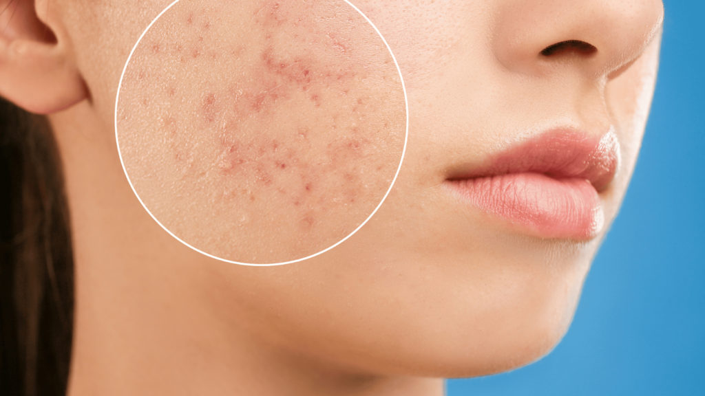 can skincare help hormonal acne?